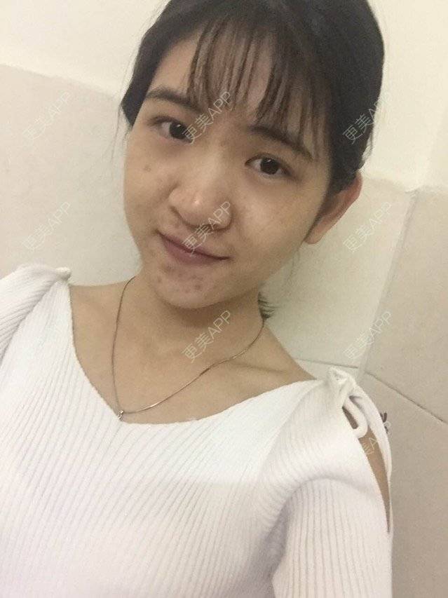 更美 - 咿呀咿呀哟。。的果酸焕肤经验 | 祛疤痕痘印 | 果酸祛痘 | 果酸焕肤 | 广州