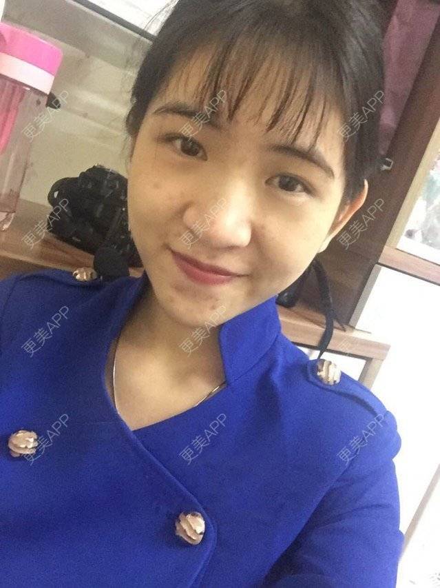 更美 - 咿呀咿呀哟。。的果酸焕肤经验 | 祛疤痕痘印 | 果酸祛痘 | 果酸焕肤 | 广州