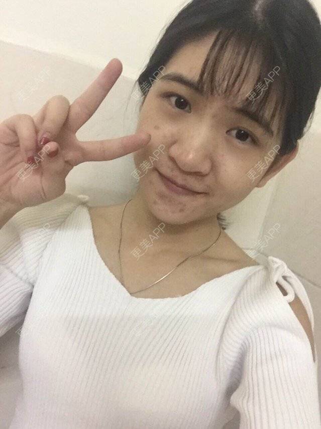 更美 - 咿呀咿呀哟。。的果酸焕肤经验 | 祛疤痕痘印 | 果酸祛痘 | 果酸焕肤 | 广州