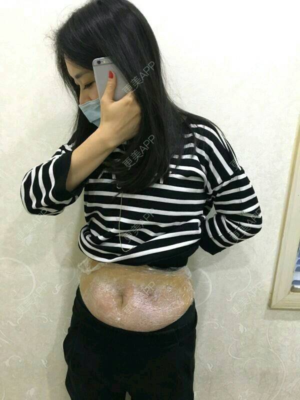 更美 - ah媛阿的妊娠纹日记 | 成都 | 成都同城 | 产后修复 | 妊娠纹