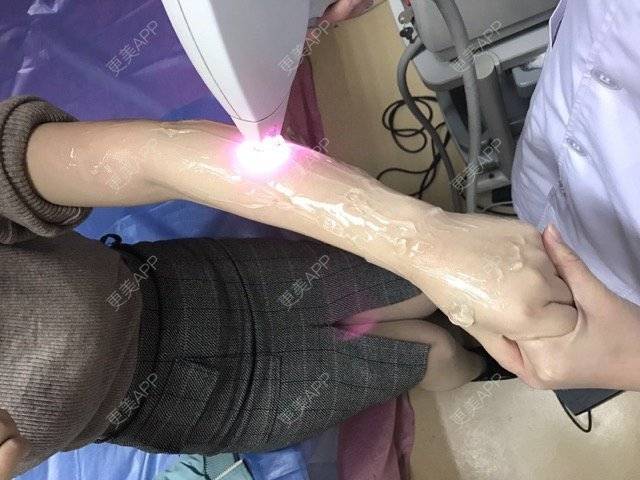 更美 - 王用洪 医生的激光脱毛经验 | 南昌 | 激光脱毛