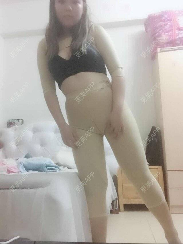 更美 - 更美用户uhjgJzL3xQ的吸脂瘦大腿经验 | 手臂吸脂 | 吸脂手术 | 吸脂瘦大腿 | 广州