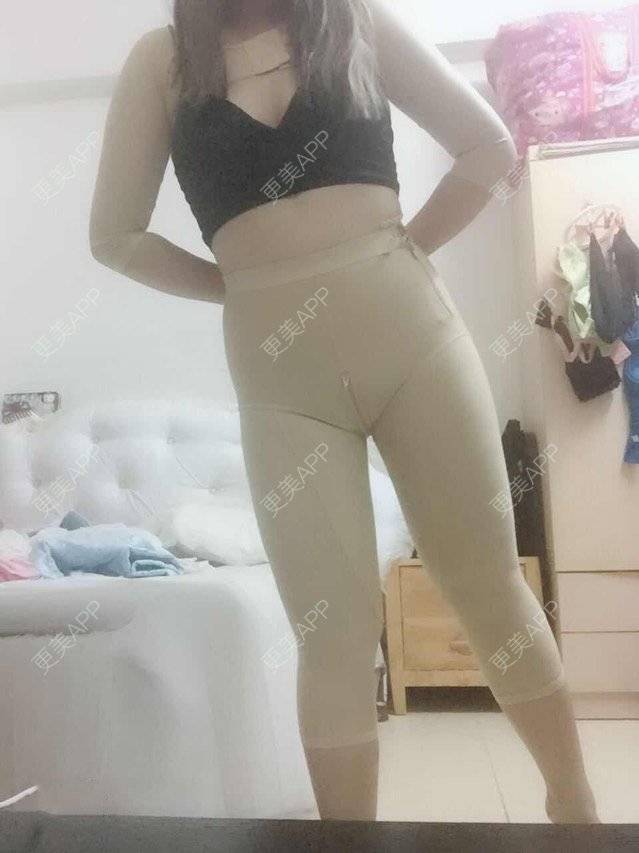 更美 - 更美用户uhjgJzL3xQ的吸脂瘦大腿经验 | 手臂吸脂 | 吸脂手术 | 吸脂瘦大腿 | 广州