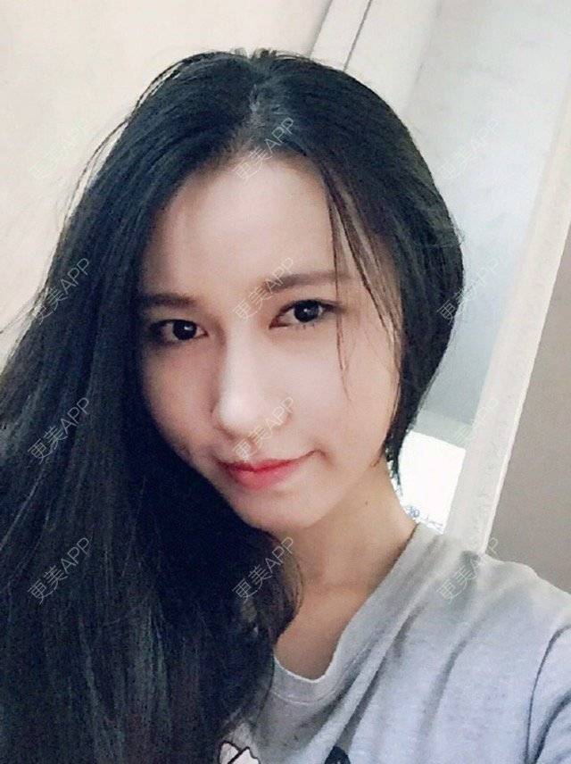 更美 - 失眠的kiki的冷光美白经验 | 冷光美白 | 广州