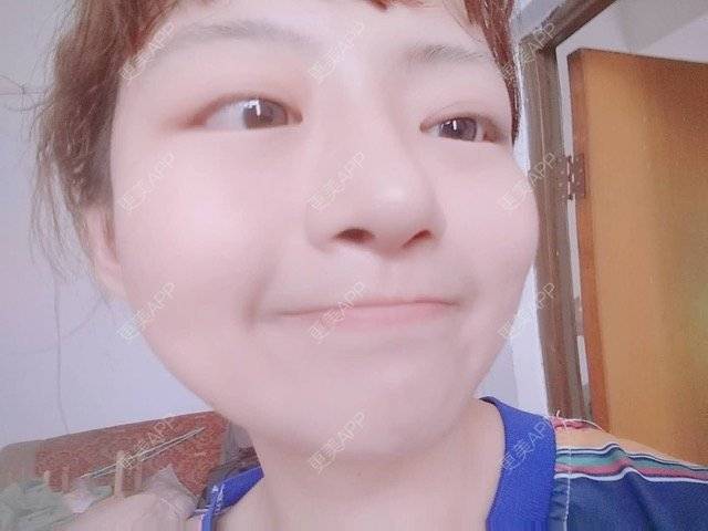 更美 - 米格m的鼻部多项经验 | 自体软骨隆鼻 | 隆鼻 | 鼻部多项 | 广州
