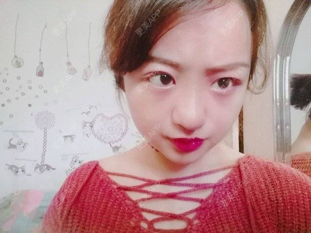 更美 - 米格m的鼻部多项经验 | 自体软骨隆鼻 | 隆鼻 | 鼻部多项 | 广州