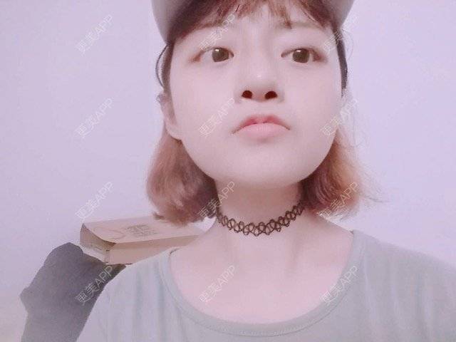 更美 - 米格m的鼻部多项经验 | 自体软骨隆鼻 | 隆鼻 | 鼻部多项 | 广州