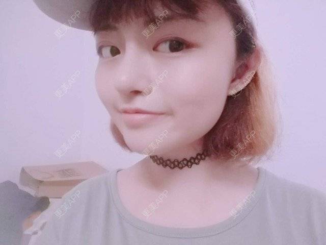更美 - 米格m的鼻部多项经验 | 自体软骨隆鼻 | 隆鼻 | 鼻部多项 | 广州