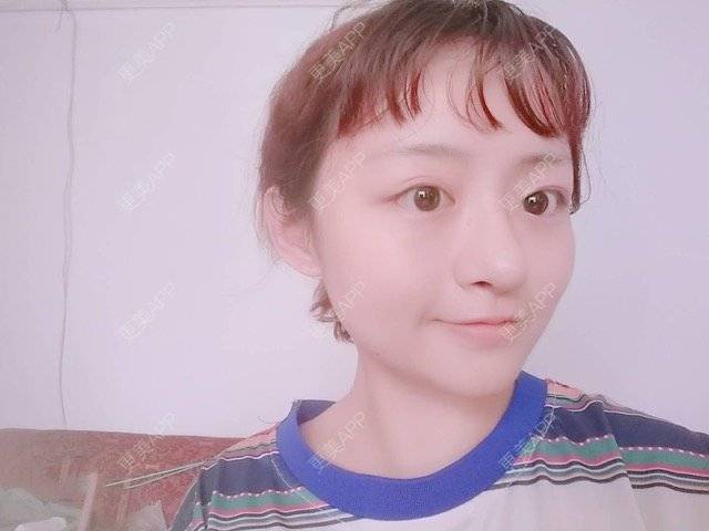 更美 - 米格m的鼻部多项经验 | 自体软骨隆鼻 | 隆鼻 | 鼻部多项 | 广州