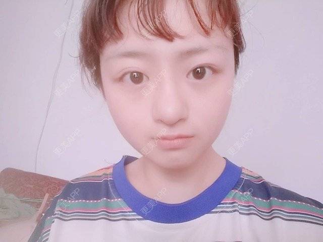 更美 - 米格m的鼻部多项经验 | 自体软骨隆鼻 | 隆鼻 | 鼻部多项 | 广州