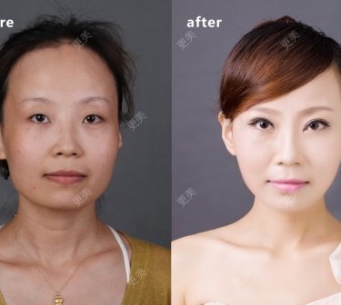 眼部整形