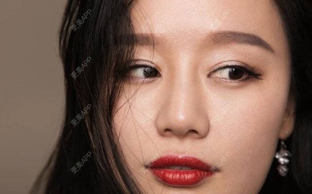 更美 - 武汉美莱医疗美容医院的全切双眼皮经验 | 全切双眼皮 | 武汉