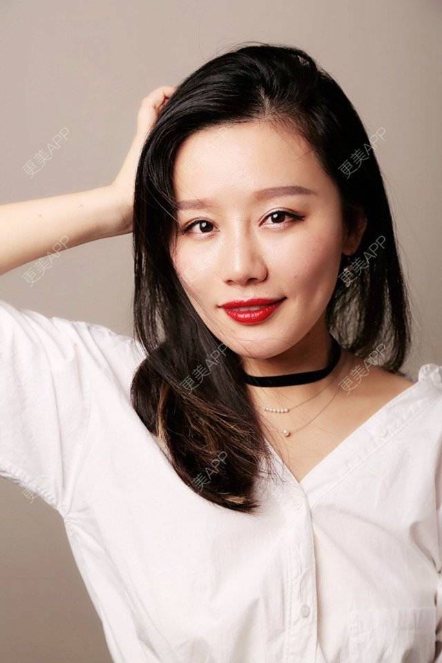 更美 - 武汉美莱医疗美容医院的全切双眼皮经验 | 全切双眼皮 | 武汉