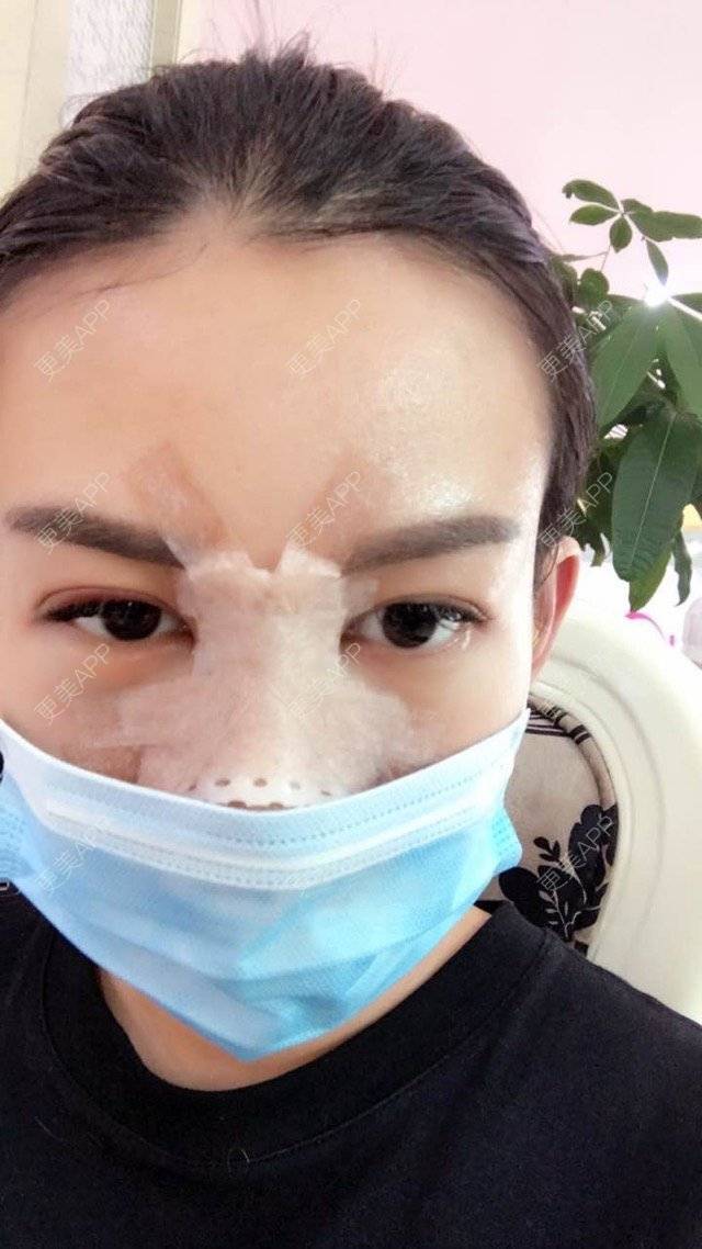 更美 - Orz 灵儿nizz的鼻部多项经验 | 假体隆鼻 | 综合隆鼻 | 鼻部多项 | 南京
