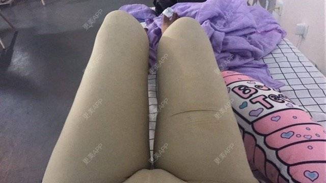 更美 - 朱渺 医生的吸脂瘦大腿经验 | 长沙 | 吸脂瘦大腿