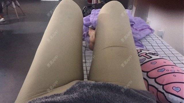 更美 - 朱渺 医生的吸脂瘦大腿经验 | 长沙 | 吸脂瘦大腿