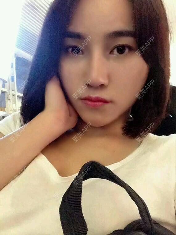 更美 - 潘俊良 医生的膨体隆鼻经验 | 膨体隆鼻 | 重庆