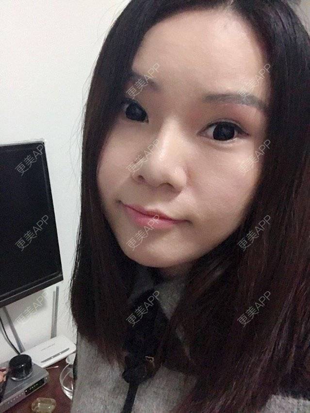 更美 - 更美用户OWoTHxmoWe的上眼睑去脂经验 | 广州 | 上眼睑去脂 | 上眼睑去脂