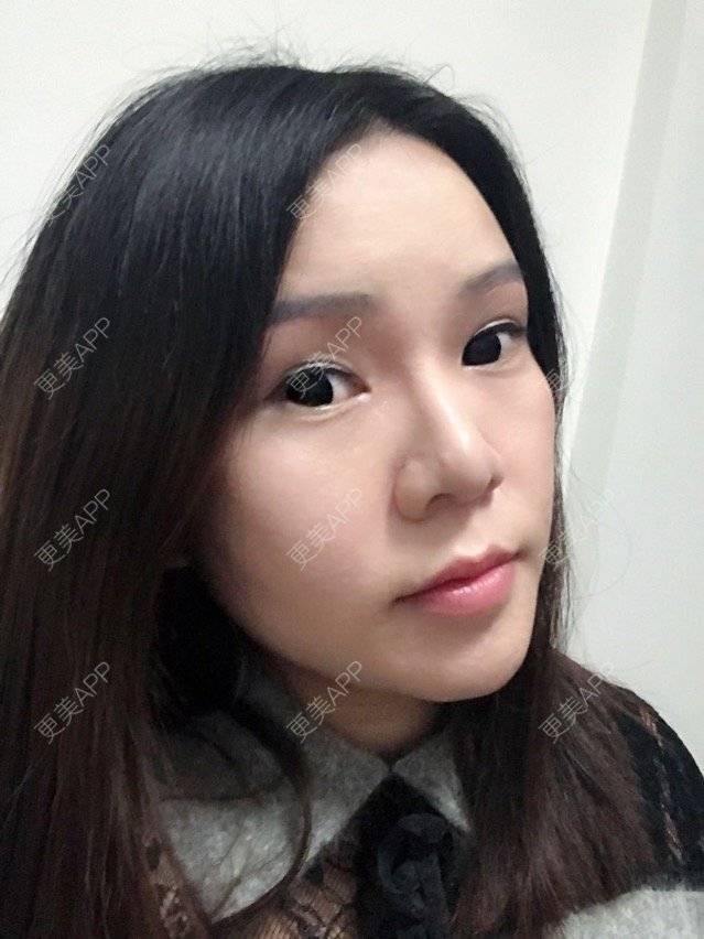 更美 - 更美用户OWoTHxmoWe的上眼睑去脂经验 | 广州 | 上眼睑去脂 | 上眼睑去脂