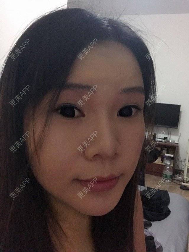 更美 - 更美用户OWoTHxmoWe的上眼睑去脂经验 | 广州 | 上眼睑去脂 | 上眼睑去脂