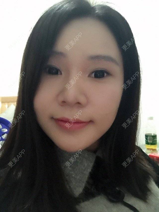 更美 - 更美用户OWoTHxmoWe的上眼睑去脂经验 | 广州 | 上眼睑去脂 | 上眼睑去脂