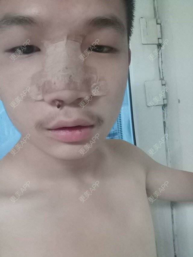 更美 - 更美用户GtB2kyPlZB的硅胶隆鼻经验 | 北京 | 硅胶隆鼻 | 全自体耳软骨隆鼻 | 隆鼻