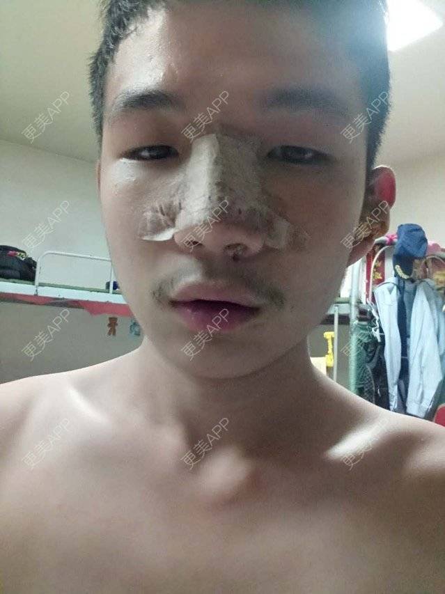 更美 - 更美用户GtB2kyPlZB的硅胶隆鼻经验 | 北京 | 硅胶隆鼻 | 全自体耳软骨隆鼻 | 隆鼻