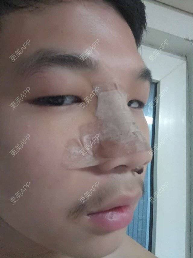 更美 - 更美用户GtB2kyPlZB的硅胶隆鼻经验 | 北京 | 硅胶隆鼻 | 全自体耳软骨隆鼻 | 隆鼻