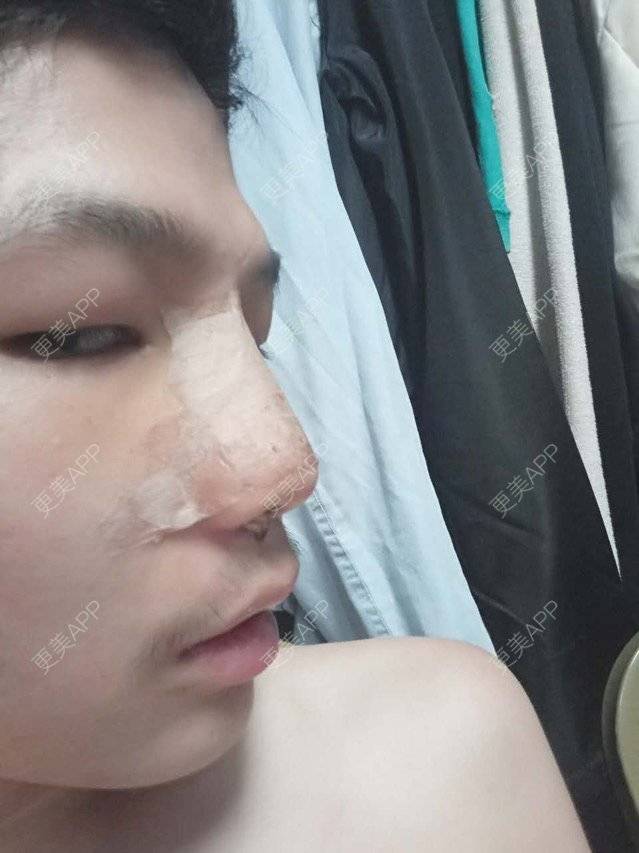 更美 - 更美用户GtB2kyPlZB的硅胶隆鼻经验 | 北京 | 硅胶隆鼻 | 全自体耳软骨隆鼻 | 隆鼻