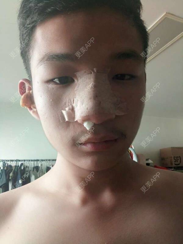 更美 - 更美用户GtB2kyPlZB的硅胶隆鼻经验 | 北京 | 硅胶隆鼻 | 全自体耳软骨隆鼻 | 隆鼻
