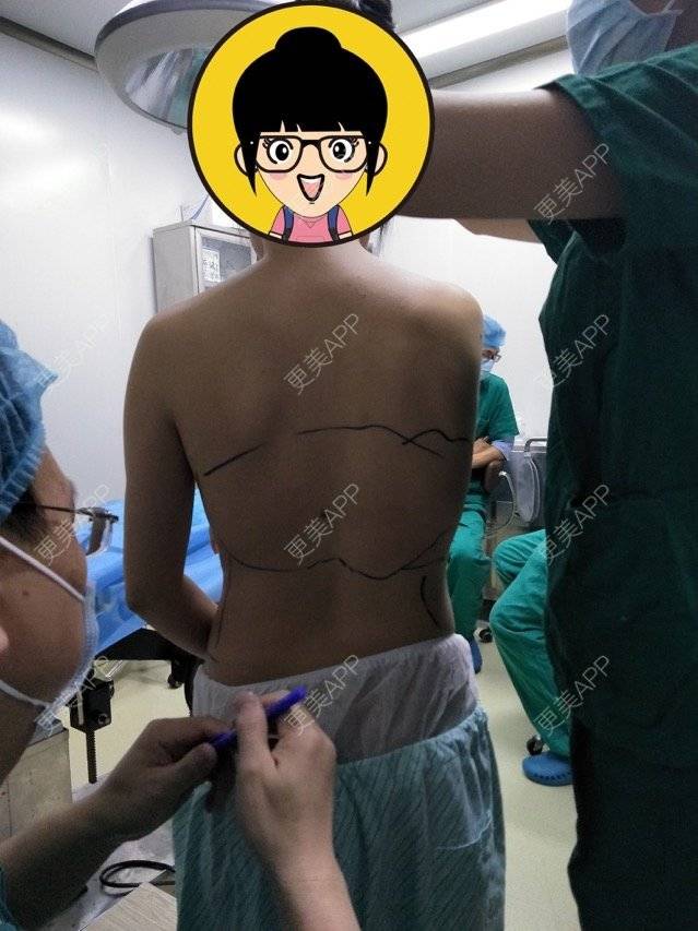 更美 - 杉杉来吃S的腰腹吸脂经验 | 侧腰吸脂 | 腰腹吸脂 | 深圳同城 | 深圳