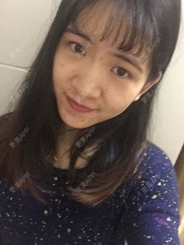 更美 - 咿呀咿呀哟。。的果酸焕肤经验 | 果酸祛痘 | 果酸焕肤 | 皮肤美容 | 广州