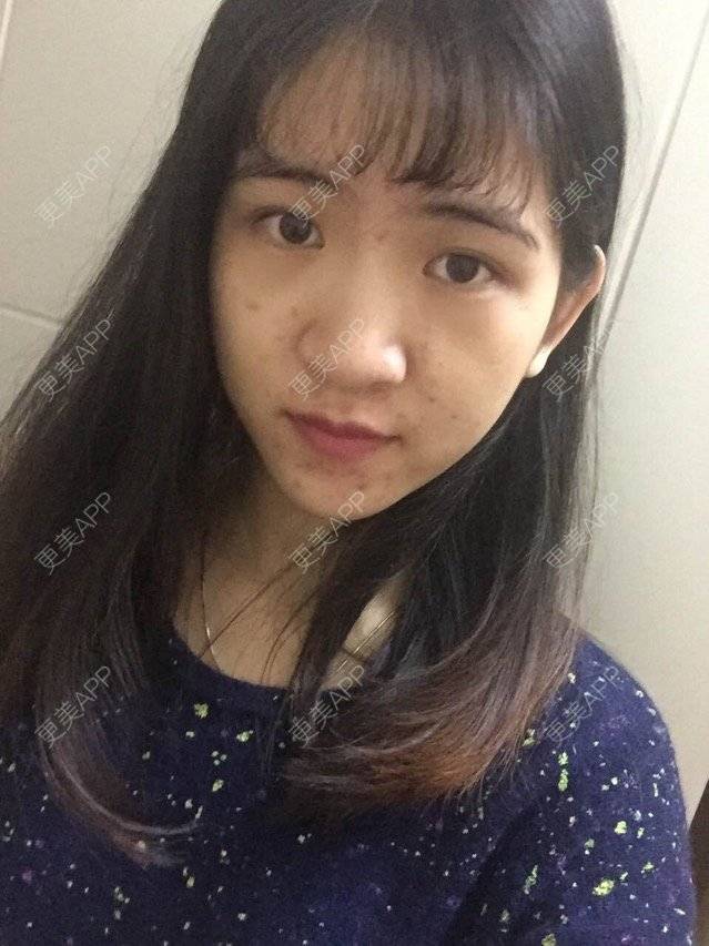 更美 - 咿呀咿呀哟。。的果酸焕肤经验 | 果酸祛痘 | 果酸焕肤 | 皮肤美容 | 广州