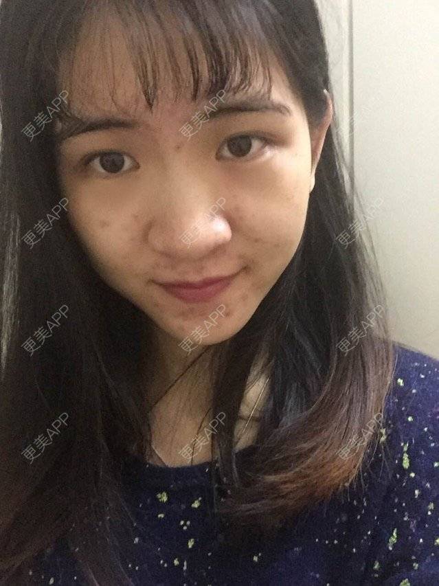 更美 - 咿呀咿呀哟。。的果酸焕肤经验 | 果酸祛痘 | 果酸焕肤 | 皮肤美容 | 广州