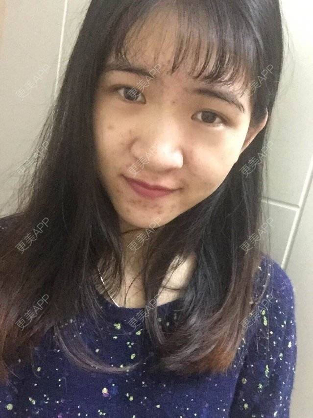 更美 - 咿呀咿呀哟。。的果酸焕肤经验 | 果酸祛痘 | 果酸焕肤 | 皮肤美容 | 广州