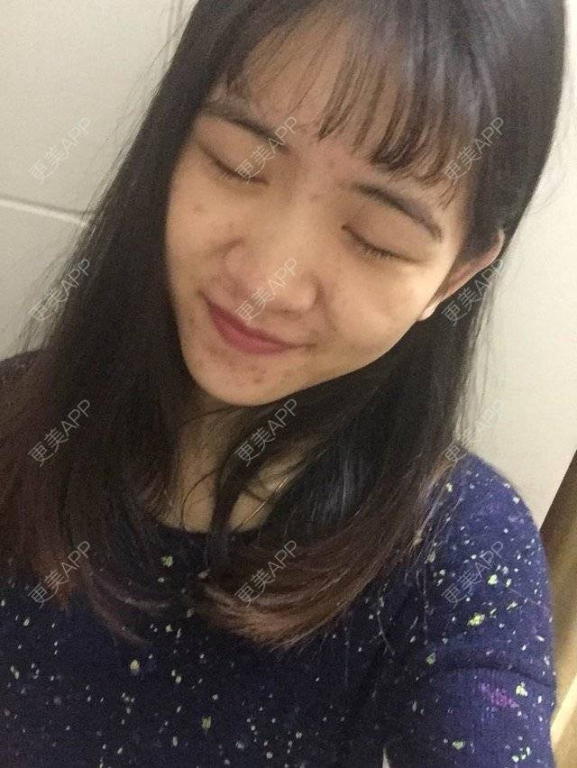 更美 - 咿呀咿呀哟。。的果酸焕肤经验 | 果酸祛痘 | 果酸焕肤 | 皮肤美容 | 广州