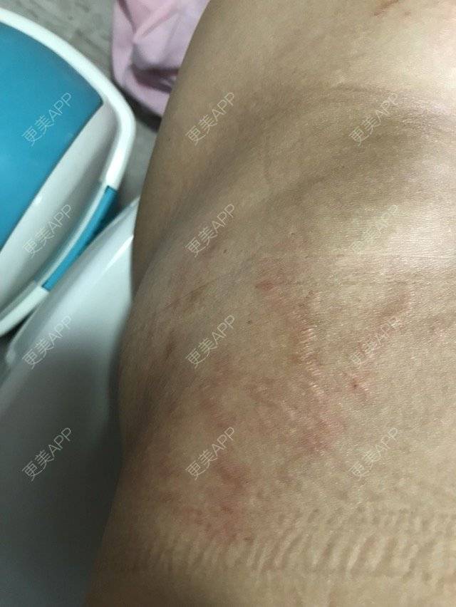 更美 - 就叫昵称吧的妊娠纹经验 | 去妊娠纹 | 妊娠纹 | 祛妊娠纹