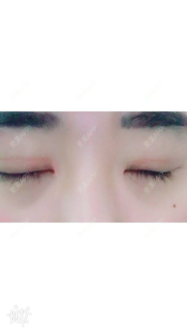 更美 - 超甜超甜的双眼皮经验 | 北京 | 视频日记 | 双眼皮