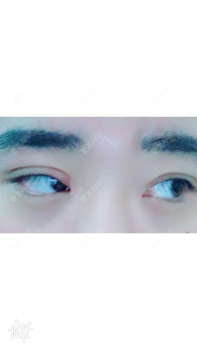 更美 - 超甜超甜的双眼皮经验 | 北京 | 视频日记 | 双眼皮