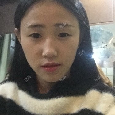 面部不对称矫正