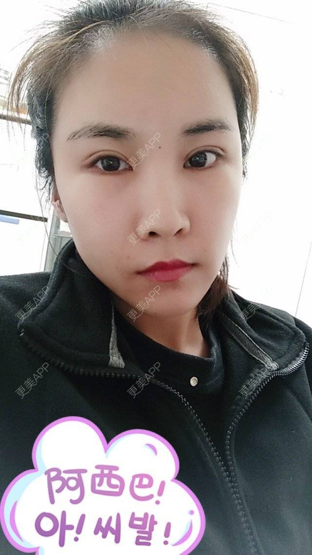更美 - 最好的我自己的定点双眼皮经验 | 眼眉整形 | 定点双眼皮 | 北京叶美人