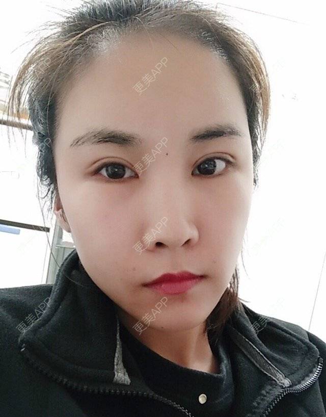更美 - 最好的我自己的定点双眼皮经验 | 眼眉整形 | 定点双眼皮 | 北京叶美人