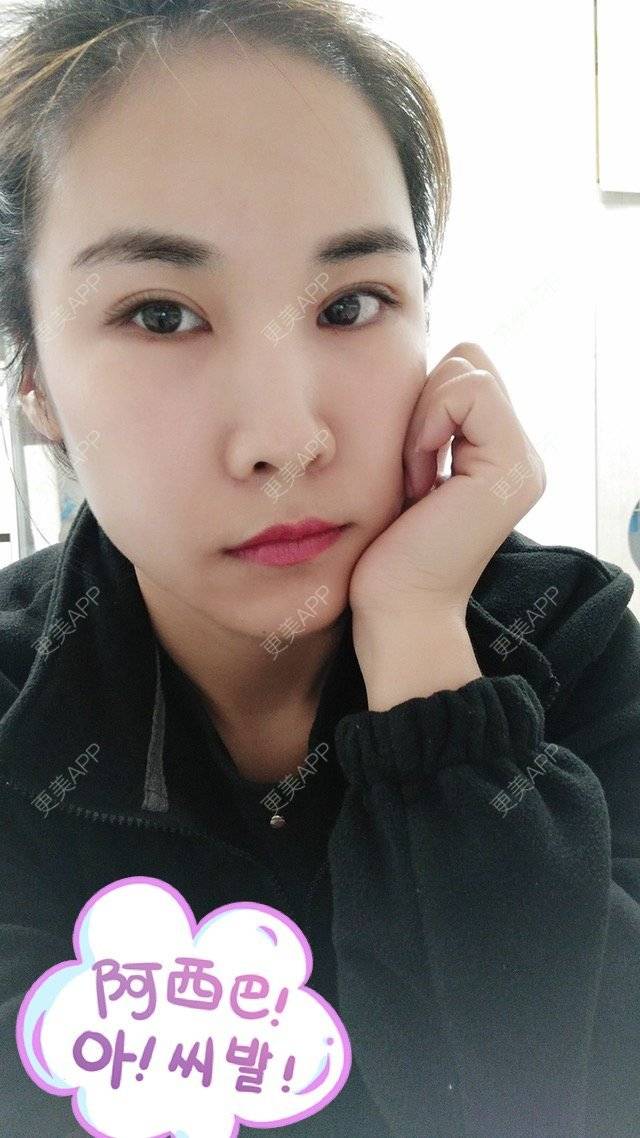 更美 - 最好的我自己的定点双眼皮经验 | 眼眉整形 | 定点双眼皮 | 北京叶美人