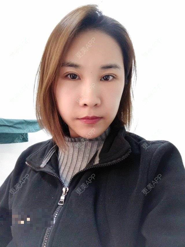 更美 - 最好的我自己的定点双眼皮经验 | 眼眉整形 | 定点双眼皮 | 北京叶美人