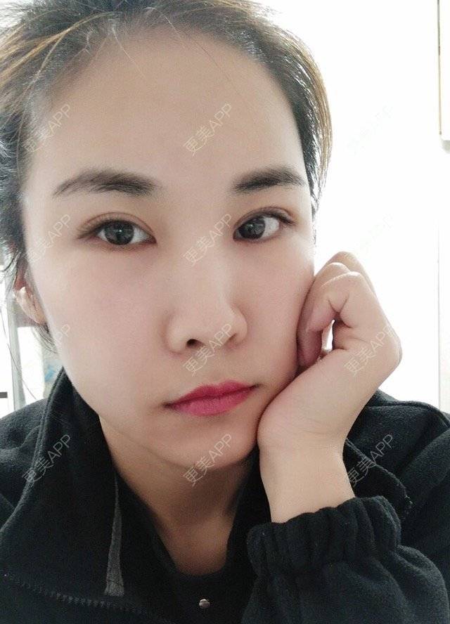 更美 - 最好的我自己的定点双眼皮经验 | 眼眉整形 | 定点双眼皮 | 北京叶美人