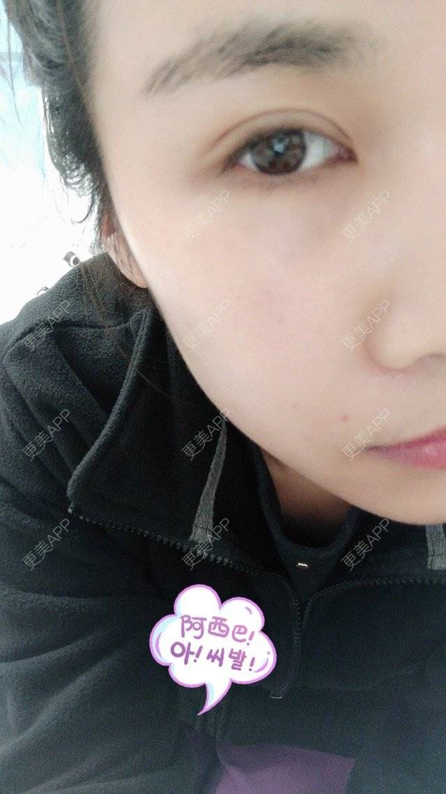 更美 - 最好的我自己的定点双眼皮经验 | 眼眉整形 | 定点双眼皮 | 北京叶美人
