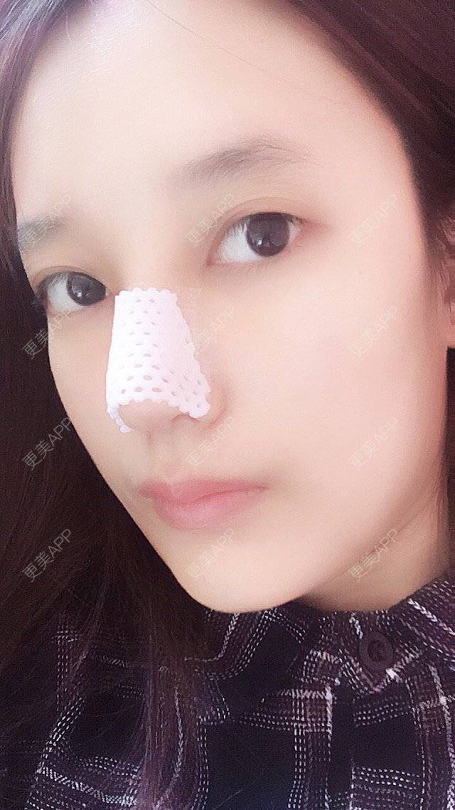 更美 - 匆匆1108的全脸整形套餐经验 | 全脸整形套餐 | 武汉 | 鼻部整形 | 隆鼻 | 鼻部多项