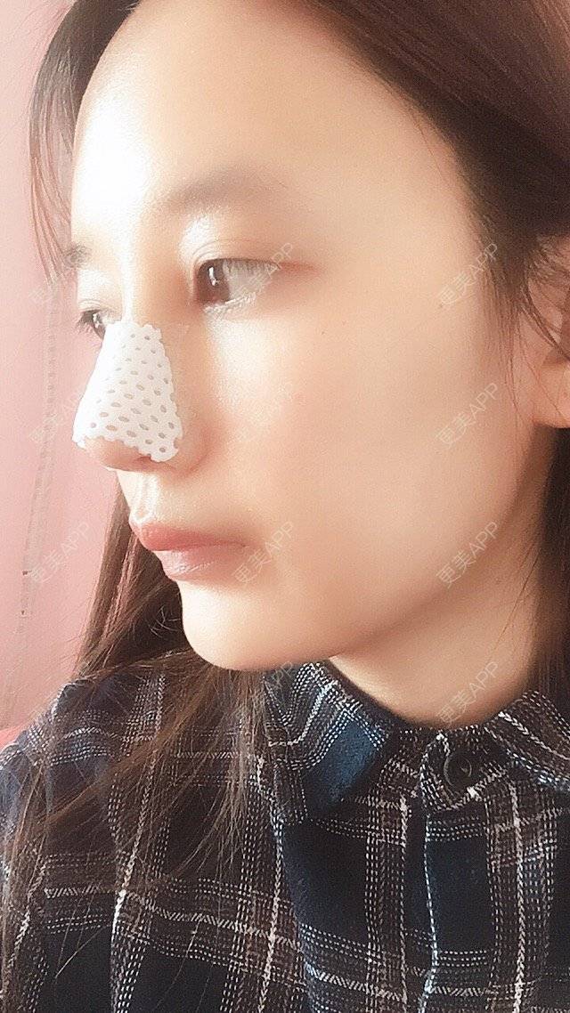 更美 - 匆匆1108的全脸整形套餐经验 | 全脸整形套餐 | 武汉 | 鼻部整形 | 隆鼻 | 鼻部多项