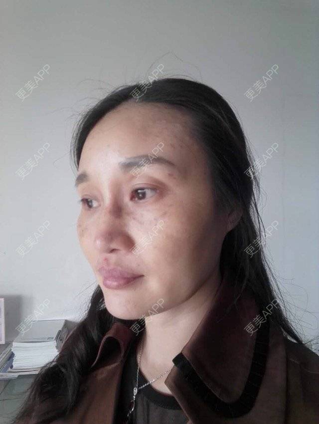 更美 - 更美用户M0GeHCOhRS的激光淡斑经验 | 激光淡斑 | 激光雀斑 | 皮肤美容 | 广州