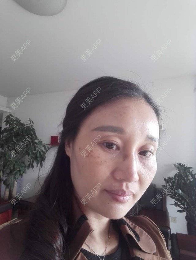更美 - 更美用户M0GeHCOhRS的激光淡斑经验 | 激光淡斑 | 激光雀斑 | 皮肤美容 | 广州